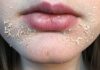 Dry Skin Around Mouth: Causes, Prevention and Remedy dry and flaky skin around mouth