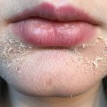 dry and flaky skin around mouth
