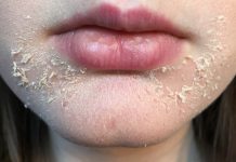 Dry Skin Around Mouth: Causes, Prevention and Remedy dry and flaky skin around mouth