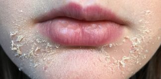 dry and flaky skin around mouth