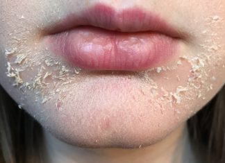 Dry Skin Around Mouth: Causes, Prevention and Remedy dry and flaky skin around mouth