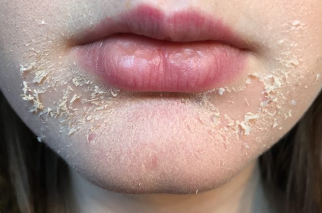 Why It Is Dry Skin Around Mouth Learn Causes And Cure Naturally