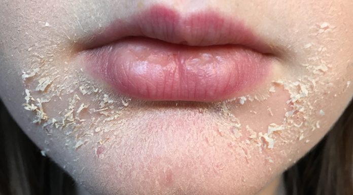 Dry Skin Around Mouth: Causes, Prevention and Remedy dry and flaky skin around mouth
