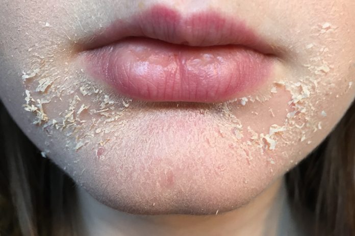 dry and flaky skin around mouth