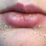 flaky skin or dry patches around the mouth