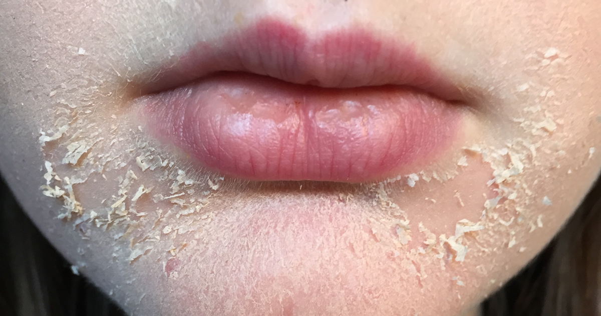 Dry Skin Patches On My Lips | Ownerlip.co