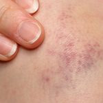 remedies for bruises with essential oils