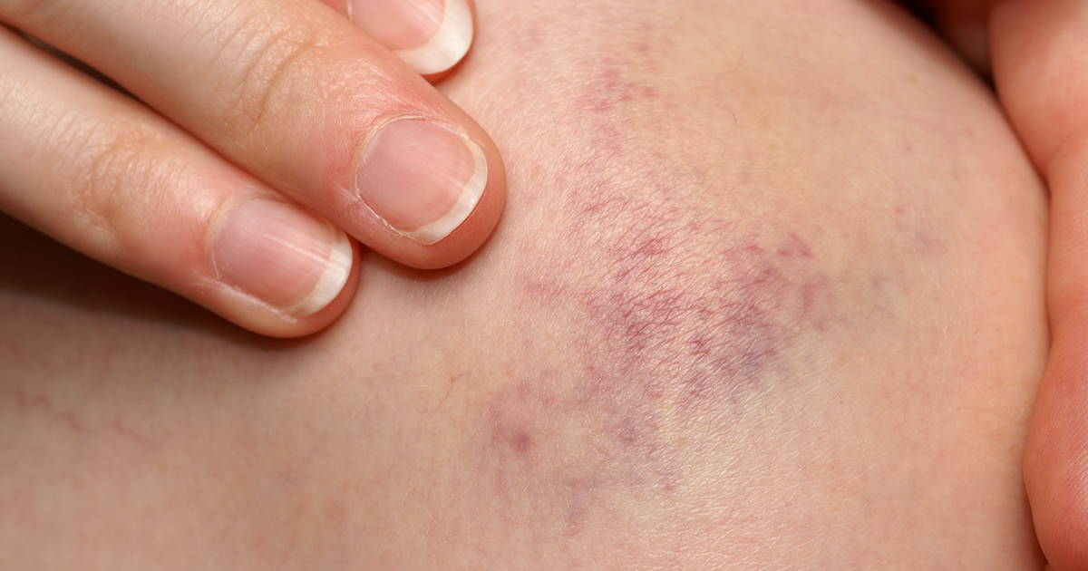 9 Essential Oils for Bruises Which Oils and How to Use Them