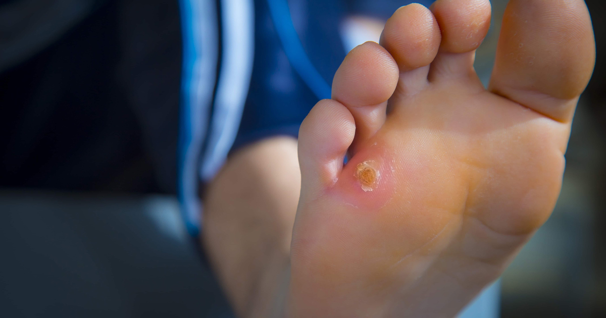 Simply Learn How To Get Rid of Corns on Feet and Toes