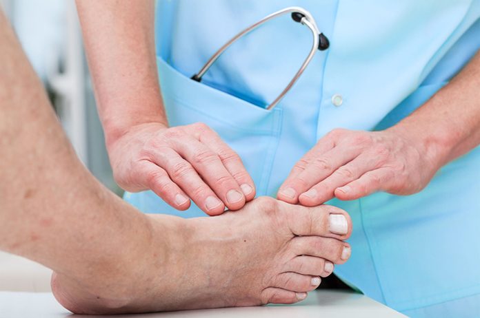 how to get rid of bunions