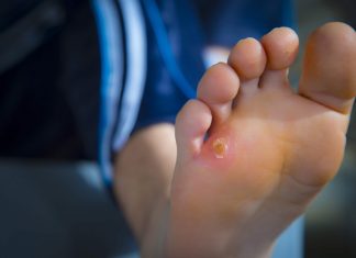 how to get rid of corns on feet and toes