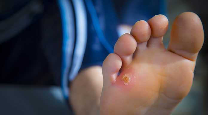 Steps on How to Get Rid of Corns on Feet and Toes how to get rid of corns on feet and toes