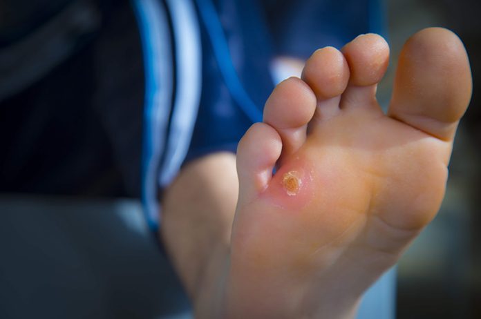 how to get rid of corns on feet and toes