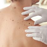 skin cancer signs