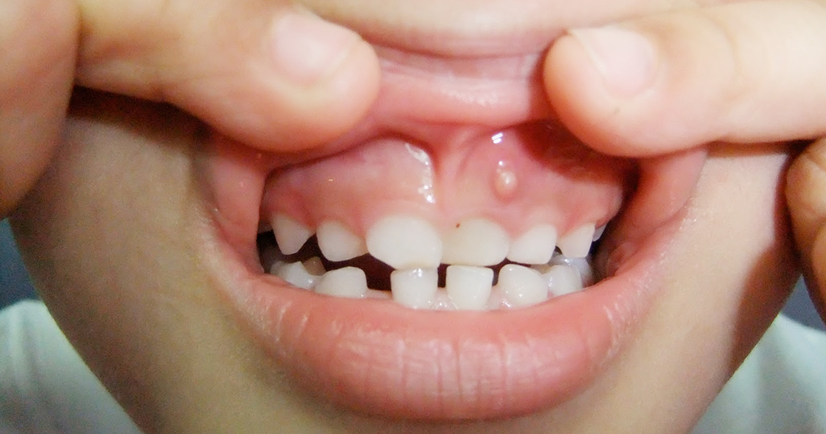 What are Gum Boils and Causes How Can They Be Treated?