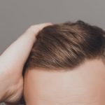 hair transplant cost and treatment