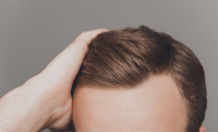 hair transplant cost and treatment hair transplant cost and treatment