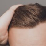 hair transplant surgery procedure