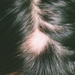 sign of alopecia areata hair loss