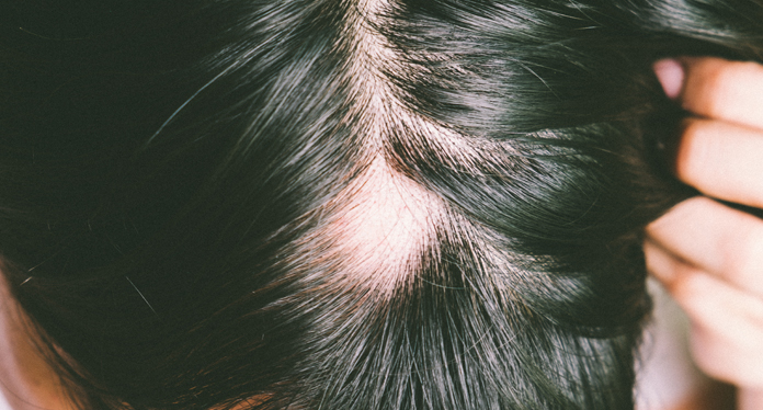 sign of alopecia areata hair loss