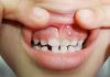What are Gum Boils and How Can They Be Treated? what are gum boils