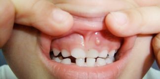 What are Gum Boils and How Can They Be Treated? what are gum boils