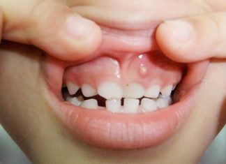 What are Gum Boils and How Can They Be Treated? what are gum boils