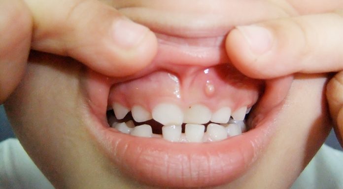 What are Gum Boils and How Can They Be Treated? what are gum boils