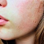 reasons treatment for perioral dermatitis