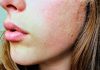 Perioral Dermatitis: Reasons, Diagnosis, Risk Factors, and Treatment what is perioral dermatitis