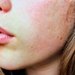 what is perioral dermatitis