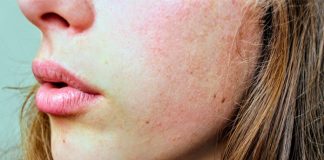what is perioral dermatitis