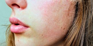 Perioral Dermatitis: Reasons, Diagnosis, Risk Factors, and Treatment what is perioral dermatitis