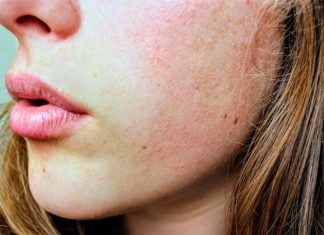 Perioral Dermatitis: Reasons, Diagnosis, Risk Factors, and Treatment what is perioral dermatitis