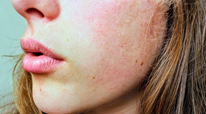 Perioral Dermatitis: Reasons, Diagnosis, Risk Factors, and Treatment what is perioral dermatitis