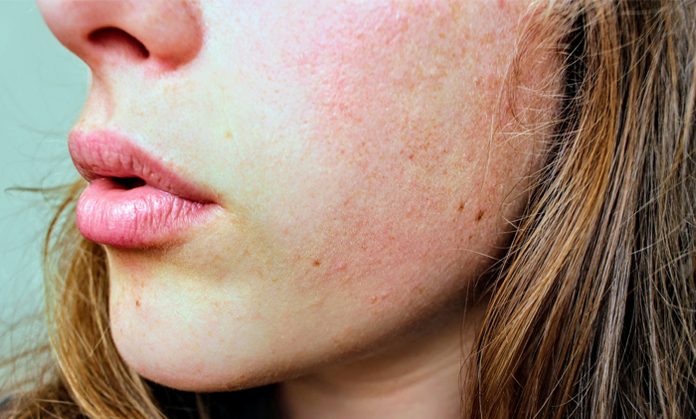 what is perioral dermatitis