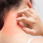how to cure hives fast