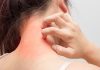 Effective Ways to get rid of hives? how to get rid of hives