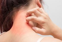 Effective Ways to get rid of hives? how to get rid of hives