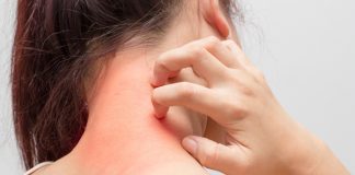 Effective Ways to get rid of hives? how to get rid of hives