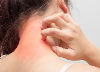 Effective Ways to get rid of hives? how to get rid of hives