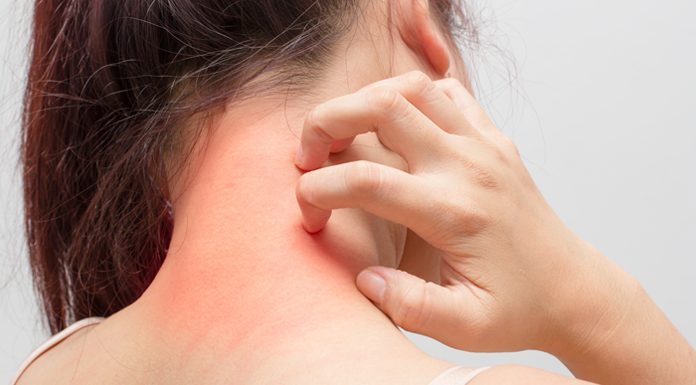 Effective Ways to get rid of hives? how to get rid of hives