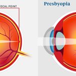 presbyopia
