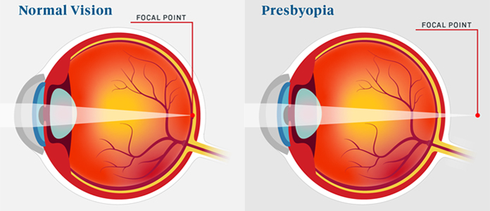 presbyopia